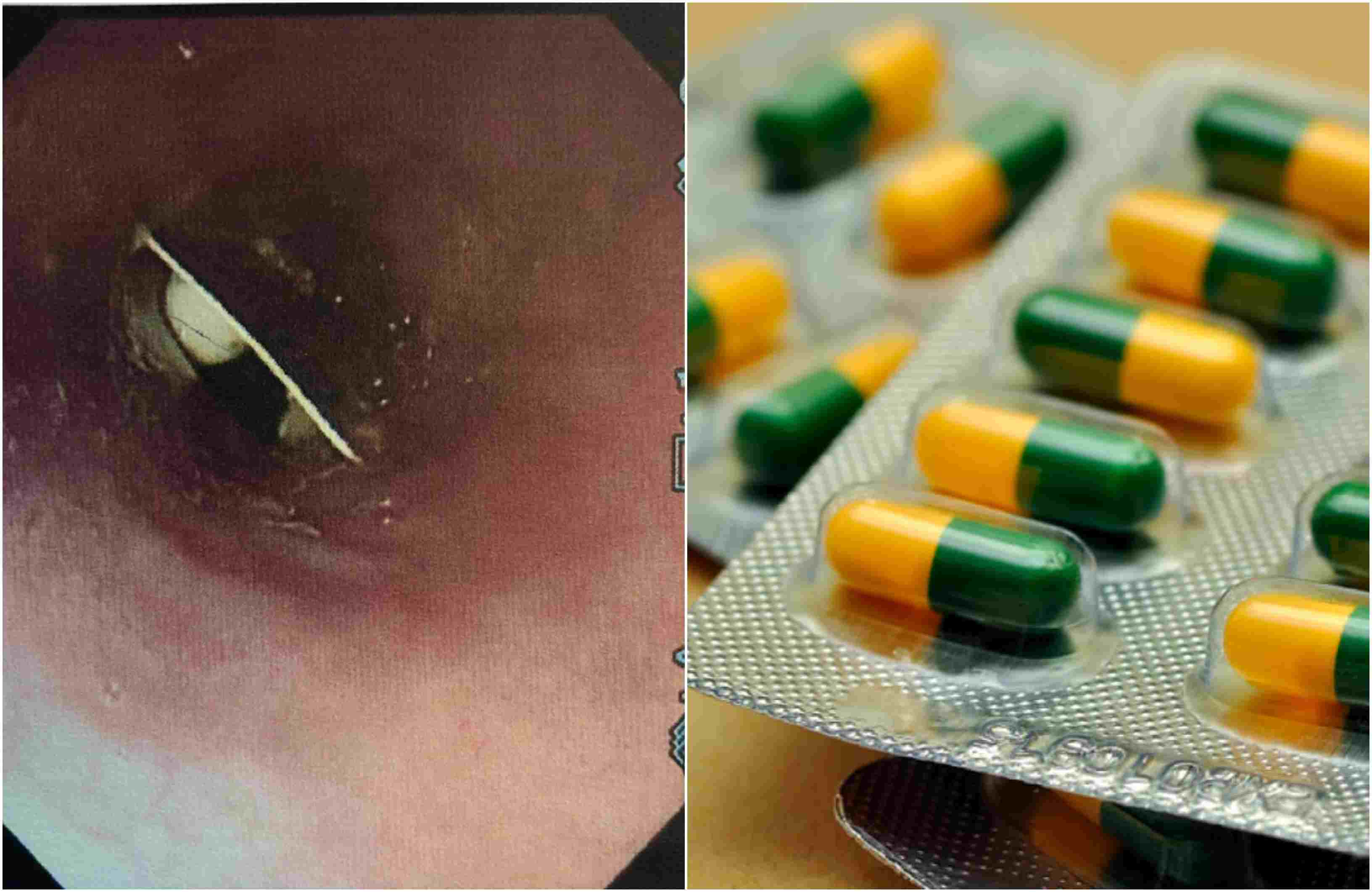 Plastic pill lodged in woman's throat